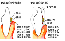 歯痛